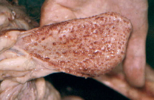 Follicular cystitis in male genitals