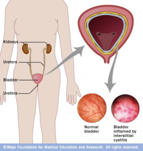 Male anatomy effected by Diagram of male anatomy effected by a urinary tract infections