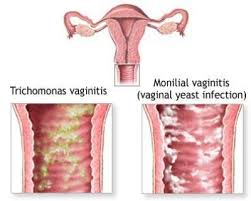 vaginitis1