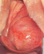Vaginitis Pictures 6 - Herpes & Coldsores Support Network Atrophic Vaginitis in female cervix
