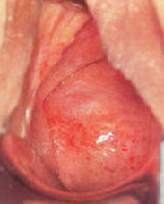 Atrophic Vaginitis in female cervix