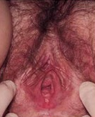 Vaginitis Pictures 5 - Herpes & Coldsores Support Network vaginitis symptoms