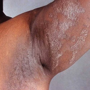 Candida overgrowth under arm