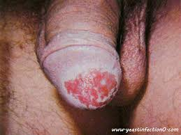  Yeast Infection picture in male