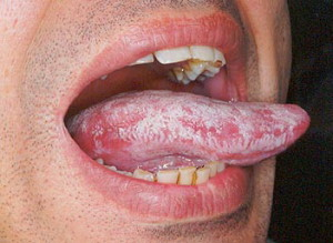 Overgrowth of candida in mouth