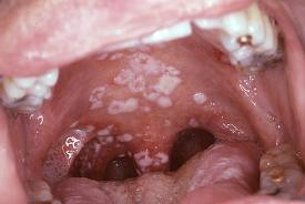 Oral candida overgrowth