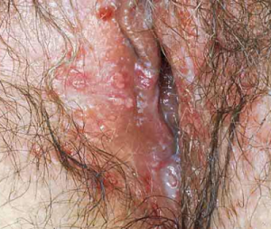 Yeast Infection picture in female genitals