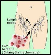 Lymphogranuloma information