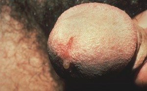 nongonococcal urethritis male